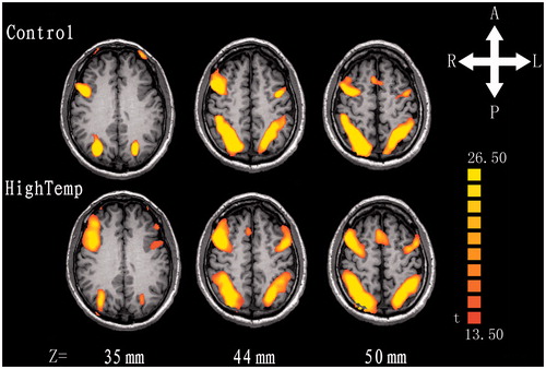Figure 2. The statistical parametric map of an axial slice of the brain shows activation inversely proportional to visual short-term memory load in the bilateral DLPFC, IPS and IOS. The maps of upper row represented the control group and the lower row represented the hyperthermia group. Z, z axial in Talairach-Tournoux coordinates; T, t value; A, anterior; P, posterior; L, left; R, right.