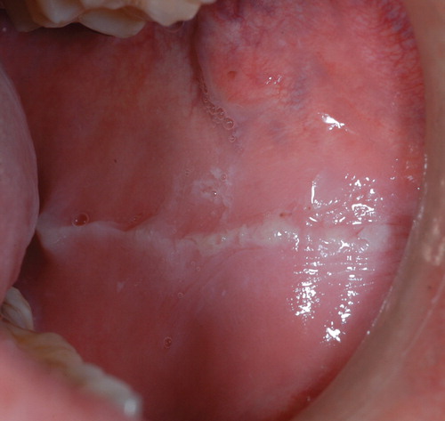 Figure 1. Representative photograph of buccal mucosa ridging (BMR). The diagnosis criterion of BMR was defined as a linear thickening on the buccal mucosa at the level where the teeth occlude.