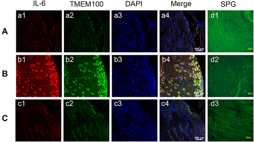 Figure 4 Immunofluorescence images (A–C) and glyoxylate staining images (D) of DRG in rats in groups A-C. Compared with the intervertebral disc degenerative pain model group A (a1) and C group (c1), the expression of IL-6 in the intervertebral disc tissue of group B (b1) intervertebral disc pain model group was significantly increased. And the expression of TMEM100 in intervertebral disc tissue of group B (b2) was also significantly higher than that of group A (a2) and group c (c2). The nucleus was stained with DAPI (a3, b3, c3). In group A (d1), group B (d2) and group C (d3) glyoxylate staining images can clearly see the nerves in the intervertebral disc.