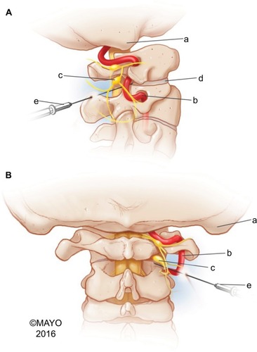 Figure 1 Anatomy of the C1–2 joint.