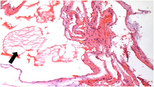 Figure 2. Histopathological image of a vocal cord cavernous hemangioma revealing the proliferation of crowding and dilated vessels with marked congestion and focal inflammation. (H&E, × 100).
