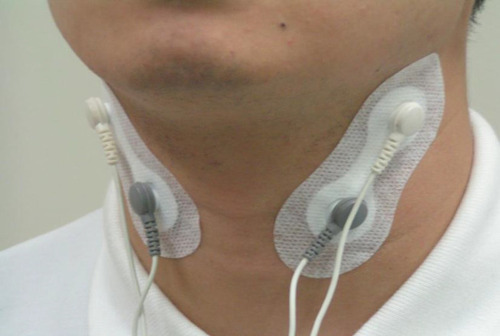 Figure 2 Positions of electrodes. The upper electrodes are placed directly below the mandibular angle, and the lower electrodes are placed at the level of the thyroid cartilage along the anterior edge of the sternocleidomastoid muscle. A 50-beat interferential wave is generated from two different alternating currents (2000 or 2500 Hz).