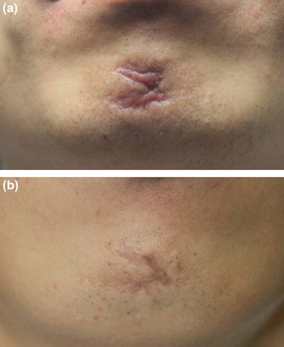 Figure 2. (a) Depressed, curved facial scar on the mid-chin and (b) marked improvement 2 months after intradermal RF treatment.
