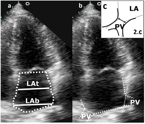 Figure 2 (a) An example of trapezoidal LA shape, LA basal diameter ˃ LA transversal diameter. (b) Practical example of LA tracing after (pulmonary vein) PV ostia definition and consecutive evaluation of shape remodelling. (c) The border of LA/PV is the line between each side of the intersection of a line tangential to the PV and LA walls.