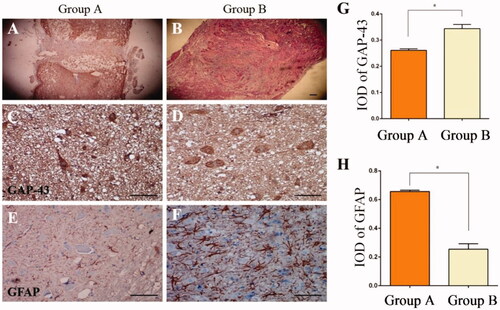 Figure 6. Spinal cord injury with HE staining, indicating that scar tissue in the nanofibrous SF scaffold group (B) was less than in the non-nanofibrous SF scaffold group (A). Transplantation of the nanofibrous SF scaffold group integrated well with the existing spinal cord, with less scar tissue (B). There was partial breakdown of the transplant in Group A, with a cavity observed within the spinal cord. Immunohistochemical staining was conducted to detect the expression of GAP-43 (C, D) and GFAP (E, F) 8 weeks after transplantation. Significant differences were observed in the absorbance value ratios for GAP-43 and GFAP in each group (p < .05), IOD: Integrated Optical Density, Control: Non-nanofibrous SF scaffold, BMSCs/Tussah SF: Nanofibrous SF scaffold, bar = 100 μm.