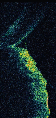 Figure 9 Cross-sectional imaging of the tear meniscus obtained by optical coherence tomography.