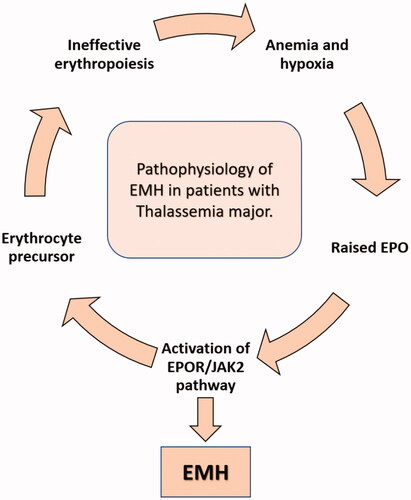 Figure 6. The pathophysiology of EMH in BTM. Concept reused with permission from Yang et al. [Citation22].
