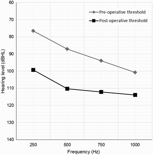 Figure 2 Last available pre-operative and post-operative pure tone audiometric thresholds for cochlear implant recipients at the University of Southampton Auditory Implant Service with at least one post-operative unaided pure tone audiogram.