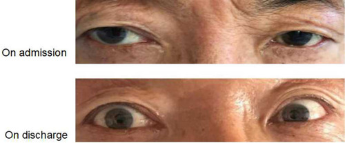 Figure 2 The pupils of the patient were not large at the time of admission; the left pupil was 7 mm, and the right pupil was 5 mm. The patient’s bilateral pupils were equally large and round when he was discharged from the hospital.