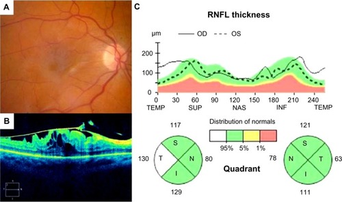 Figure 5 Fundus photograph (A), SD-OCT image of the macula (B) and SD-OCT optic nerve analysis (C) illustrating thickened T-RNFL in a patient with epiretinal membrane of the macula in the right eye compared with the fellow control eye. Note that the T-RNFL measures 130 μm in the eye with epiretinal membrane compared with 63 μm in the normal left eye