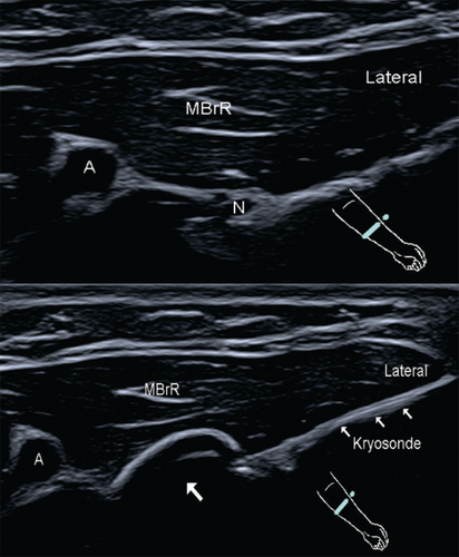 Figure 3. Transverse ultrasound image of the superficial radial nerve in the middle (N) before and during cryoneurolysis.An ‘ice ball’ (arrow) is formed at the tip of the cryoprobe in the area of the superficial radial nerve ramus.A: Radial artery; MBrR: Brachioradialis muscle; N: Superficial radial nerve.