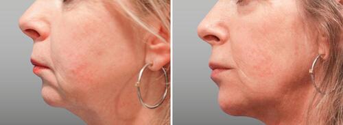 Figure 14 Before and after photos of a patient treated for chin elongation. Courtesy of Sonja Sattler, MD.