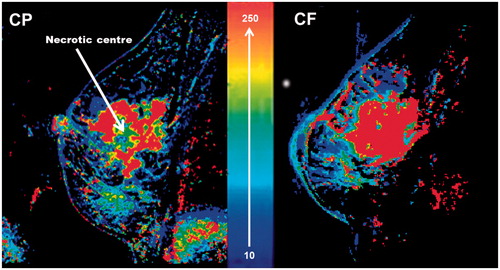 Figure 1. Wash-in parameter (WiP) maps generated from DCE-MRI in LABC patients. WiP maps are surrogates for perfusion/permeability [Citation7]. The right image shows the CF enhancement pattern which is a uniform enhancement from centre to periphery. The left image is the CP enhancement pattern which is an inhomogeneous ring-type enhancement. The 10–250 scale represents the range of the WiP as previously described in detail [Citation7].