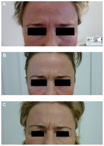 Figure 1 Clinical photographs taken at maximum frown. (A) Patient prior to injection with incobotulinumtoxinA on December 24, 2009, after developing nonresponsiveness to preparations containing botulinum toxin complex. (B) Patient following injection with incobotulinumtoxinA on January 19, 2010, after the patient developed nonresponsiveness to preparations containing botulinum toxin complex. (C) Patient on February 25, 2010, about 1 month after the final botulinum toxin type A injection on January 19, 2010.