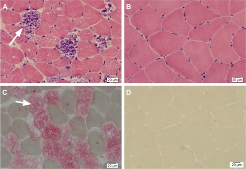 Figure 1 Hematoxylin–eosin staining showed the different sizes of muscle fiber, and lots of basophilic cavitation (arrow) contains amorphous materials in muscle fiber (A). (B) is normal. Acid phosphatase staining showed the increase of acid phosphatase activity, which caused the vacuolation turn ragged-red (arrow), and enzyme activity of the vacuoloid unchanged muscle fiber got a slight increase, which was stellate distributed (C). (D) is normal. (×400).