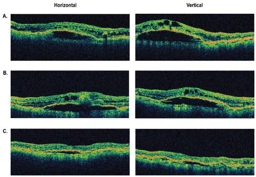 Figure 3 Representative optical coherence tomography (OCT) images of an eye with retinal angiomatous proliferation that had improvement in macular and subretinal pigment epithelial fluid between 4 and 8 weeks following a single intravitreal injection of bevacizumab. A) Baseline OCT images through central macula. B) OCT images at 4 weeks. C) OCT images at 8 weeks.