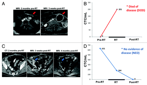 Figure 3. Serial imaging and corresponding CTC counts for bladder cancer patients C1 and C2, in relationship to radiation therapy (RT). (A) Axial image from C1’s abdomen/pelvis MRI scans at indicated time points. Red arrow indicates site of recurrence at 1 mo post-RT. (B) Graph of C1’s CTC counts at indicated time points demonstrating upward trend. (C) Axial image from C2’s abdomen/pelvis CT or MRI scans at indicated time points. Blue arrow shows area of MRI enhancement in right pelvis at 1 mo post-RT which resolved at 4 mo post-RT. (D) Graph of C2’s CTC counts at indicated time points demonstrating downward trend.