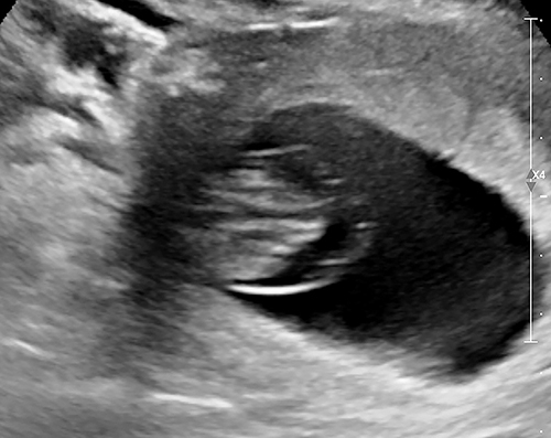 Figure 5 First-trimester septated cystic hygroma in a 41 year-old P1 diagnosed with early fetal demise at 10 weeks’ gestation. The patient declined noninvasive prenatal screening prior to uterine evacuation, yet karyotype of products of conception confirmed fetal Trisomy 18.