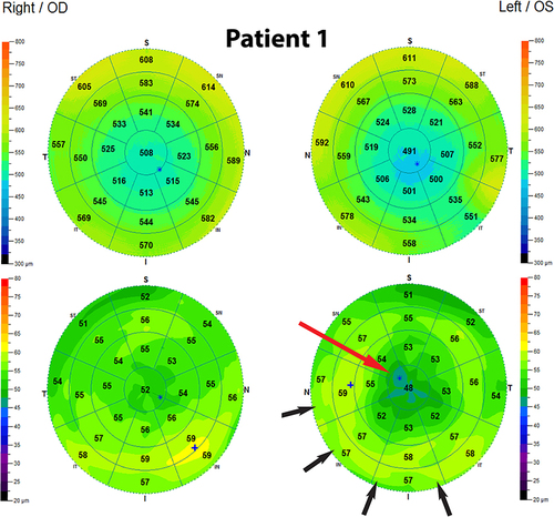 Figure 1 OCT pachymetry and ETM demonstrating normal epithelial thickness OD but marked thinning centrally (red arrow) and thickening peripherally (black arrows) OS in a “doughnut” pattern consistent with KC.