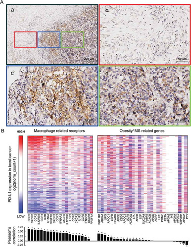 Figure 2. IHC staining of PD-L1 in TNBC specimen, and the relationship of PD-L1 expression with macrophage-derived cytokine corresponding receptors and with obesity/MS promoting genes in TCGA breast dataset