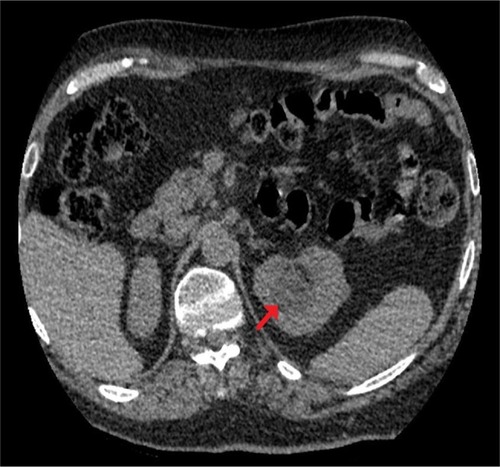 Figure 2 CT of urinary tract.