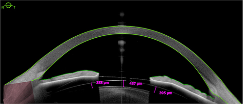 Figure 1 Anterior segment OCT image of postoperative vault with caliper values. Courtesy of Francisco Pastor-Pascual, Oftalvist Valencia.