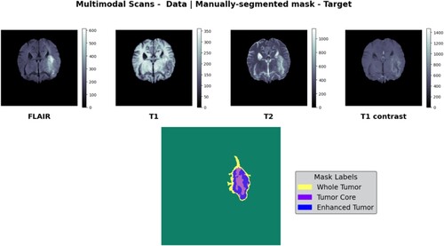 Figure 5. BraTs2021 native (T1) and post-contrast (T1Gd) T1-weighted (T1Gd) volumes, T2-weighted (T2) and T2-FLAIR volumes 3D MRI Images.