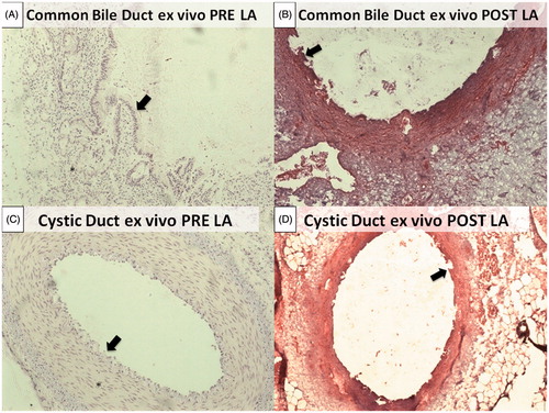 Figure 3. Normal histological structure of the common bile duct. The most superficial layer is organised as a single columnar epithelium, composing pleats and folds (black arrow). The underlying portion is made up of a dense connective tissue (*) (A). Normal histological structures of the cystic duct. The surface epithelium is composed of tall, uniform and columnar cells (black arrow). Deeper circular, longitudinal and oblique smooth muscle fibres without distinct layers can be identified (*) (C). Coagulative necrosis of the most superficial portion can be observed for both the common bile duct and cystic duct with rare craters induced by the ablation. Wall integrity turned out to be preserved in both cases (B) and (D).