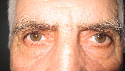 FIGURE 1.  Left oculomotor nerve palsy at initial presentation during the second attack.