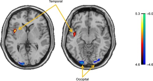 Figure 3 Brain regions with different abnormal metabolism in PD patients relative to normal subjects detected by interaction analysis of 18F-FDG PET scans with SPM across Chongqing and Shanghai cohorts. Metabolism in PD patients from the Shanghai cohort exhibited a greater increase (red) in the right temporal-striatal area, but a more significant decrease (blue) in the bilateral occipital region compared with imaging from the Chongqing cohort. The thresholds of the color bars represent T values.