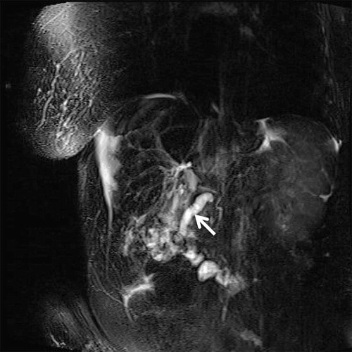 Figure 1. Magnetic resonance cholangiopancreatography