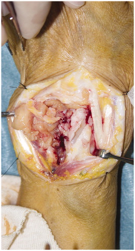 Figure 2. Intraoperative picture at the first debridement showing granuloma around the wrist joint.