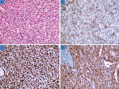 Figure 1. (a) Histomorphological appearance of the leiomyosarcoma (H&E, 200×). (b) Weak expression of AQP3 in leiomyosarcoma tissue (Immunoperoxidase, 200×). (c) Strong expression of AQP7 in leiomyosarcoma tissue (Immunoperoxidase, 200×). (d) Moderate expression of AQP9 in leiomyosarcoma tissue (Immunoperoxidase, 200×).