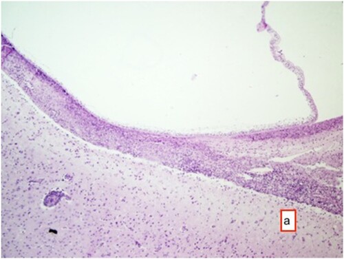 Figure 5. Cyst membrane (arrow) and mononuclear cell infiltrate in these areas with occasional eosinophil granulocytes, and perivascular mononuclear cell infiltrates HE ×200.