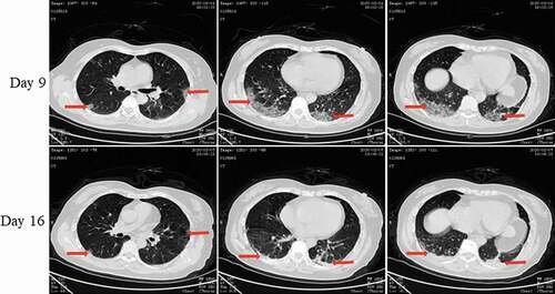 Figure 5. Chest CT scans on days 9 and 16 after onset for Pt-3. CT showed scattered bilateral multiple high-density effusions, faintly exudative shadows along the lungs with partial fibrosis on day 9. Effusions were absorbed and most were fibrotic, and the lesions were incompletely absorbed on day 16. Red arrows indicate typical lesions.
