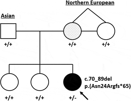 Figure 1. Pedigree representing both parents, maternal aunt (identical twin sister) and children. The proband, indicated by the arrow, has complex microphthalmia and a heterozygous SOX2 c.70_89del variant. The mother has a presumed forme fruste coloboma and a dotted shading to denote suspected mosaicism