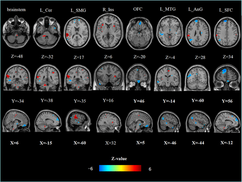 Figure 1 Group-differences of the resting-state functional connectivity of the left NAc. Higher (blue) and lower (red) resting-state functional connectivity was found in the patients with cLBP compared to the HC.