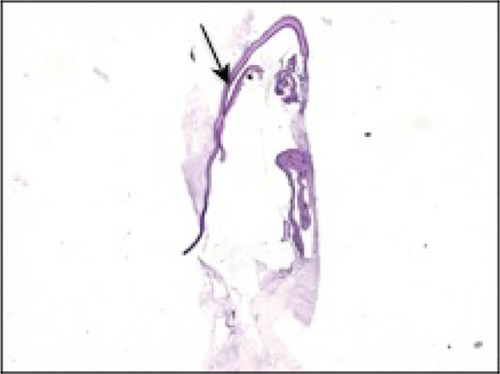 Figure 3 Microscopy of retained Descemet’s membrane (arrow) stained with periodic acid-Schiff.