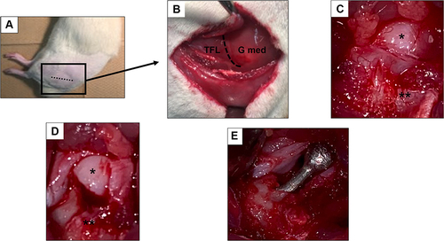 Figure 2 Macroscopic images during surgery. (A) Surgical position, (B) after incision of the fascia, (C) before cutting the joint capsule, (D) exposed Hip joint, (E) after femoral head replacement; dotted line, incision line; *Femoral head; **Greater trochanter.