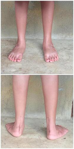 Figure 9 Near normal looking feet and no recurrence of clubfoot at twelve months; previous callosity had resolved with neutral to mild valgus heels.