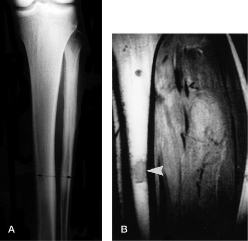 Figure 2. Ewing's sarcoma of the fibula with a skip lesion on the shaft of the tibia, not evident on conventional radiographs (A) but clearly seen on the MR scan (B).
