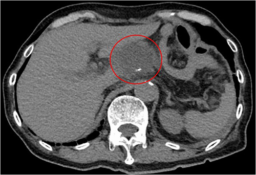 Figure 1 Abdominal CT scan showing a hypo-absorptive area (red circle) of approximately 4 cm in diameter at the esophageal-jejunal anastomosis, suggesting an abscess.