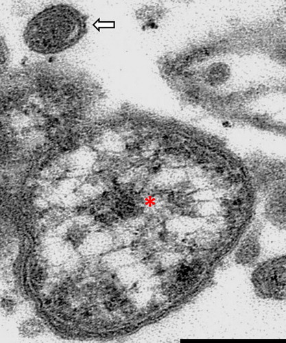 Figure 3. Coxiellosis in hyacinth macaw (case 2). Transmission electron micrograph, 19,000×. An aggregate of bacteria, showing a single large cell variant with electron lucent vacuoles and an electron dense core (asterisk), and a single small cell variant above it (arrow). The small cell variant is almost uniformly electron dense. Note the trilaminar wall of the bacteria. Bar = 0.15 µm.