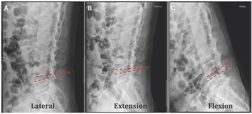 Figure 3 (A) Normal lateral measurement IVA. (B and C) The sagittal range of motion (sROM) of L4-5 was defined as the sum of absolute value of the hyperextension and hyperflexion angles.