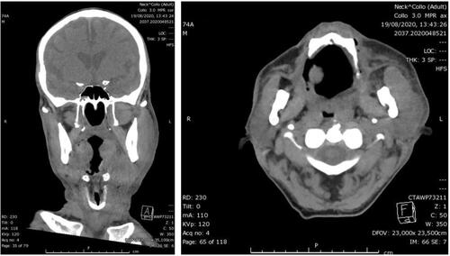 Figure 5 CT scans of submandibular and laterocervical sarcoma.