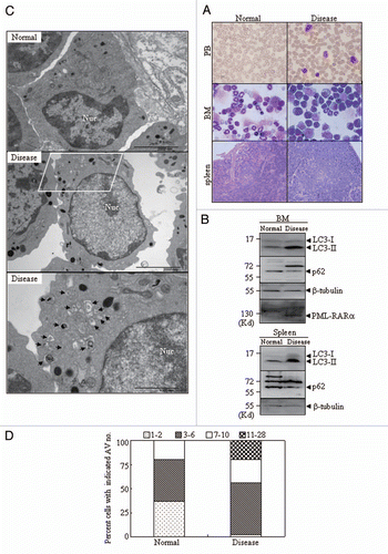 Figure 2 In vivo effect of PML-RARα expression on autophagy in leukemic mice. Leukemic cells (3 × 105) from BM and spleen of APL transgenic mice were injected into FVB/N mice via the tail vein. Animals were sacrificed about 29 d after leukemic cell transplantation. (A) Cytologic analysis by Wright's Giemsa staining of peripheral blood (PB) and BM. Histopathological sections of spleen from the indicated mice were stained with H&E. Images were observed by microscopy with a Nikon digital camera. (B) The proteins from BM cells and spleens of the normal and diseased mice were extracted and the indicated proteins were detected by protein gel blot. (C) Representative electron micrographs of myelocytes and promyelocytes in BM from normal and diseased mice were observed by TEM. The scale bars were 2,000 nm on the top images and the high-magnification picture (bottom part) was from the framed area of the middle part (scale bar = 1,000 nm). (D) The percentage of cells with the indicated AV numbers per immature granulocyte in BM from the indicated mice were calculated and summarized. All experiments were repeated three times and similar results were obtained.