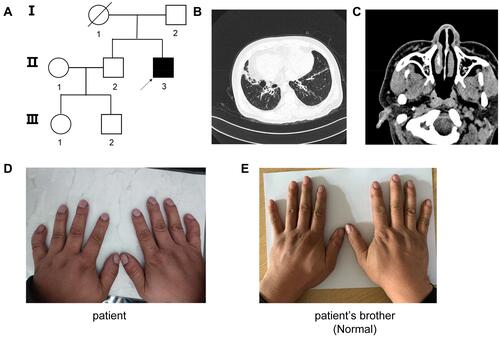 Figure 1 (A) Pedigree of the family with inherited OFD1 variant. Black arrow, proband; solid symbol, affect family members; crossed-out symbols subject who has passed away. (B) CT scan showed bronchiectasis with infection and situs inversus. (C) CT scan showed sinusitis. (D) The clubbing fingers and mild streblomicrodactyly of the patient. (E) The fingers of patient’s brother. No significant deformity has been found.