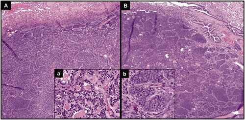 Figure 2. Hematoxylin & eosin staining of both lung nodules confirming metastases from the previous ACC, with basaloid neoplastic cells arranged in a predominantly solid architecture (A and B, original magnification 40×), presenting some cribriform areas, with glandular structures containing amorphous material (inset a; original magnification 200×) and some mitotic features (inset b; original magnification 400×).
