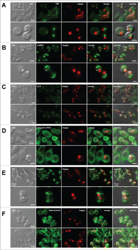 Figure 6. Distribution of additional subcellular markers in Russel body-positive cells. Fluorescent micrographs of HEK293 cells transfected with N35W variant LC construct. On day-2 post transfection, suspension cultured cells were seeded onto poly-lysine coated glass coverslips and statically incubated for 24 hr. On day-3, cells were fixed, permeabilized, and co-stained with Texas Red-conjugated anti-kappa chain polyclonal antibody and specific antibodies against various subcellular markers. (A) A recycling endosome marker, transferrin receptor (TfR). The boxed area in the first row is digitally magnified and shown in the second row. (B) A lysosome marker, LAMP1. Arrowhead shown in the second row points to lysosome–RB contact area. (C) An autophagosome marker, LC3. Regardless of the RB phenotype, LC3 is not upregulated under normal cell culture conditions used. (D) Poly-ubiquitinated proteins were stained with anti-ubiquitin monoclonal antibody (clone FK2). (E) A mitochondrial membrane marker, Tom20. (F) A microtubule component β-tubulin. Green and red image fields were superimposed to create ‘merge’ views. DIC and ‘merge’ were superimposed to generate ‘overlay’ views. Unlabeled scale bar represents 10 μm.