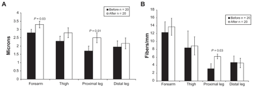 Figure 1 A) Mean ± SE dendritic length (Microns) at 4 sites before and after 18 weeks of topiramate treatment. Significant differences (ANOVA) are shown. B) Mean ± SE nerve fiber density (Fibers/mm) in skin at different sites before and after 18 weeks of topiramate treatment. A significant change was only found in proximal leg.
